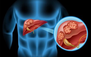 Diagnosis: Liver Cancer
