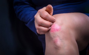 6 Common Types of Psoriasis