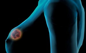 Types of Breast Cancer