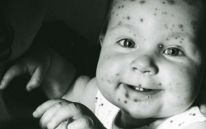 What You Need To Know About Chickenpox and Shingles