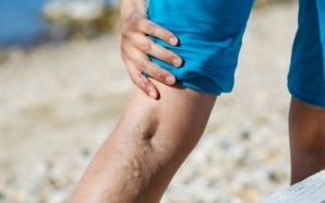 How To Treat Deep Vein Thrombosis