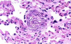 treatment pulmonary embolism, pulmonary embolism treatment, pulmonary embolism treatments, treatments for pulmonary embolism, treatment for pulmonary embolism, pulmonary embolism info, amniotic fluid embolism