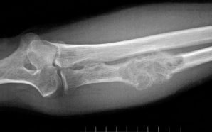 Symptoms and Signs of Bone Cancer