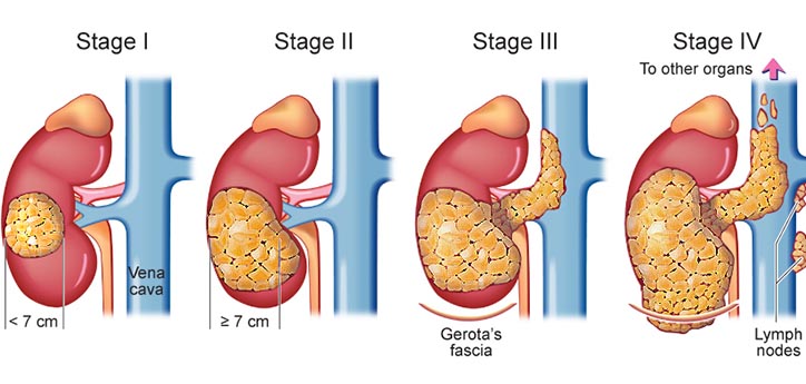 metastatic renal cell carcinoma treatment, renal cell carcinoma diagnosis, metastatic renal cell carcinoma, metastatic renal cell carcinoma treatments, What is Renal Cell Carcinoma Cancer?, metastatic renal carcinoma treatments, metastatic renal cell carcinoma diagnosis, renal cell carcinoma treatment, renal cell carcinoma, alternative kidney cancer treatment, advanced kidney cancer treatments, kidney cancer survival rates, treatment advanced kidney cancer, metastatic kidney cancer treatments, treatment for metastatic kidney cancer