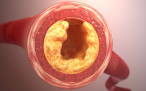 treatment pulmonary embolism, pulmonary embolism treatment, pulmonary embolism treatments, treatments for pulmonary embolism, treatment for pulmonary embolism, pulmonary embolism info